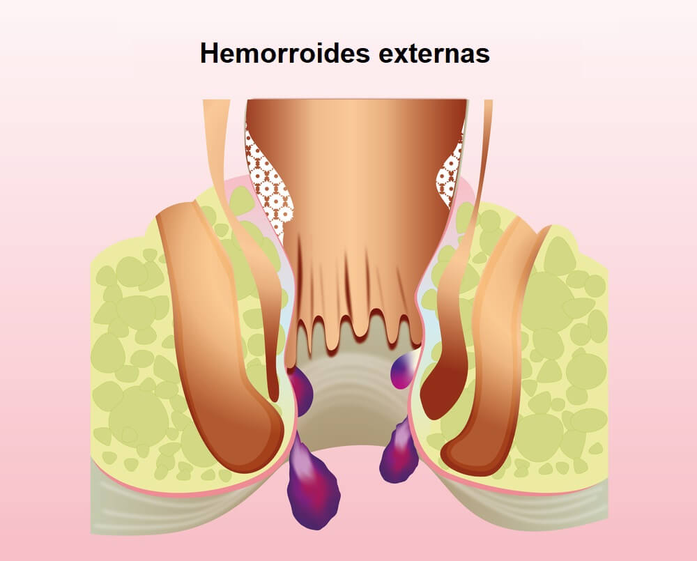 ESQUEMA-DE-HEMORROIDES-EXTERNAS-TIPOS-DE-HEMORROIDES
